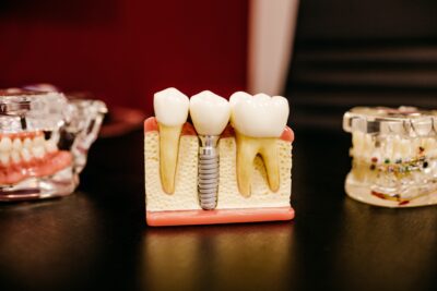 Redwood City, CA Dentist Offers Dental Implant Services
