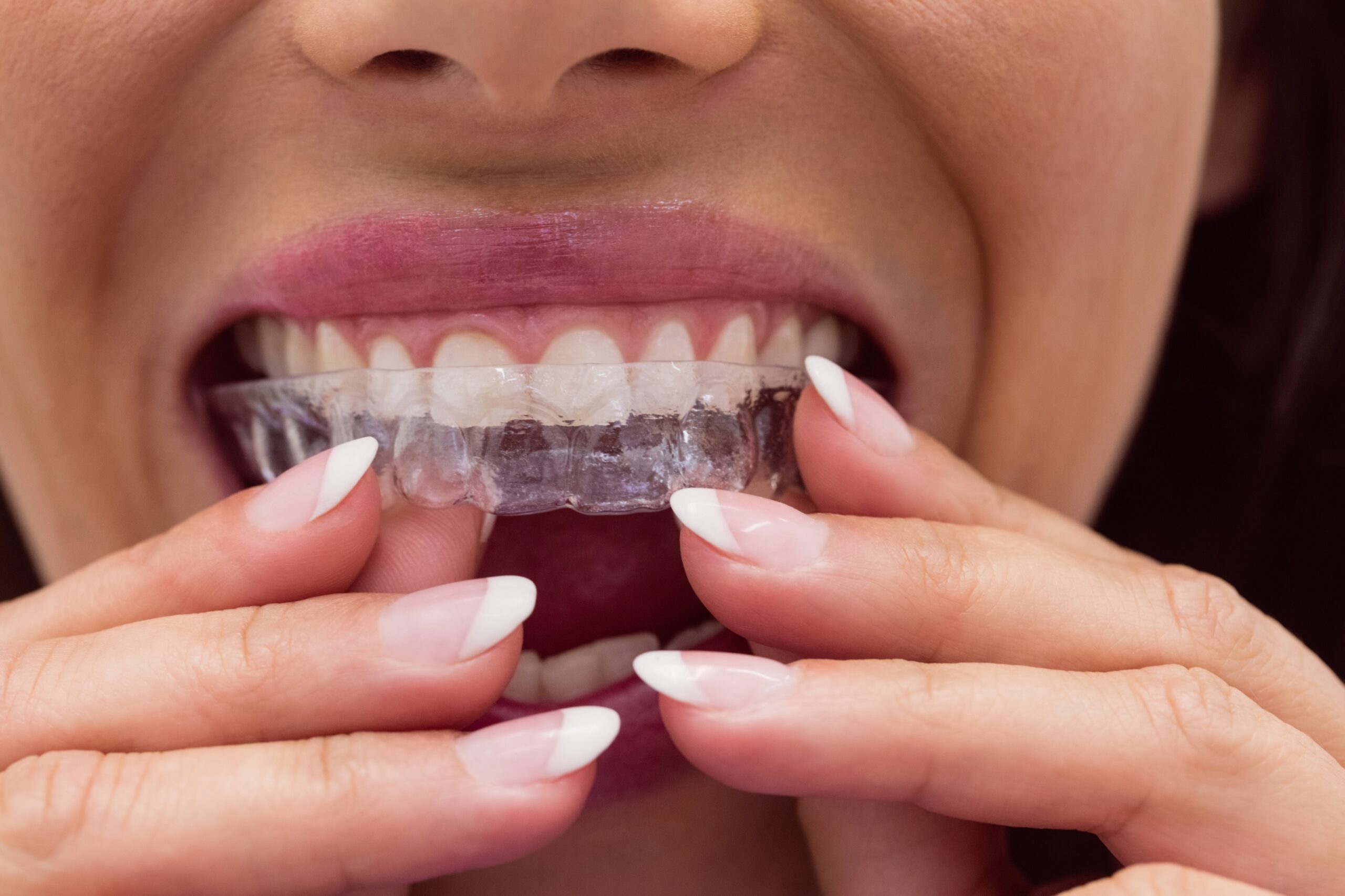 invisalign Redwood City