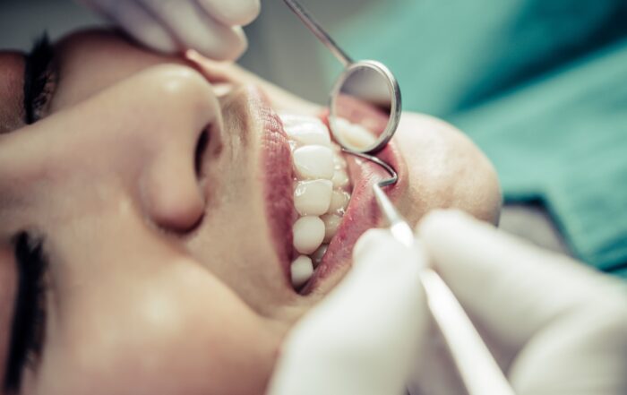 Tips on How to Avoid Requiring Dental Fillings