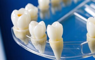 Dental implants Redwood City: How to Find the Best Implant Dentists in Redwood City