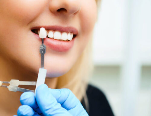 Are Veneers Worth It? A Redwood City Dentist Explains