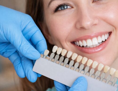Top Benefits of Getting Dental Veneers in Redwood City, CA