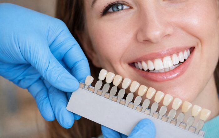 Top Benefits of Getting Dental Veneers in Redwood City, CA