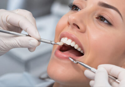 Dental Bonding for Cavities in Redwood City